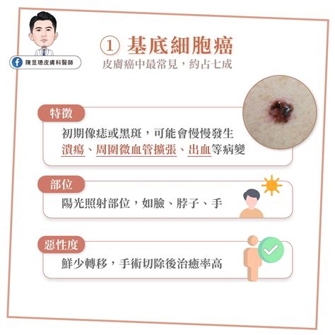 痣 斑|皮膚長痣、長斑是皮膚癌前兆？皮膚癌初期4大症狀快。